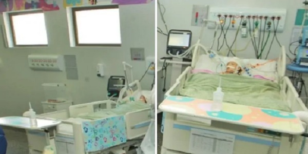 Siamesa separada tem crise convulsiva e piora em quadro de saúde, diz boletim